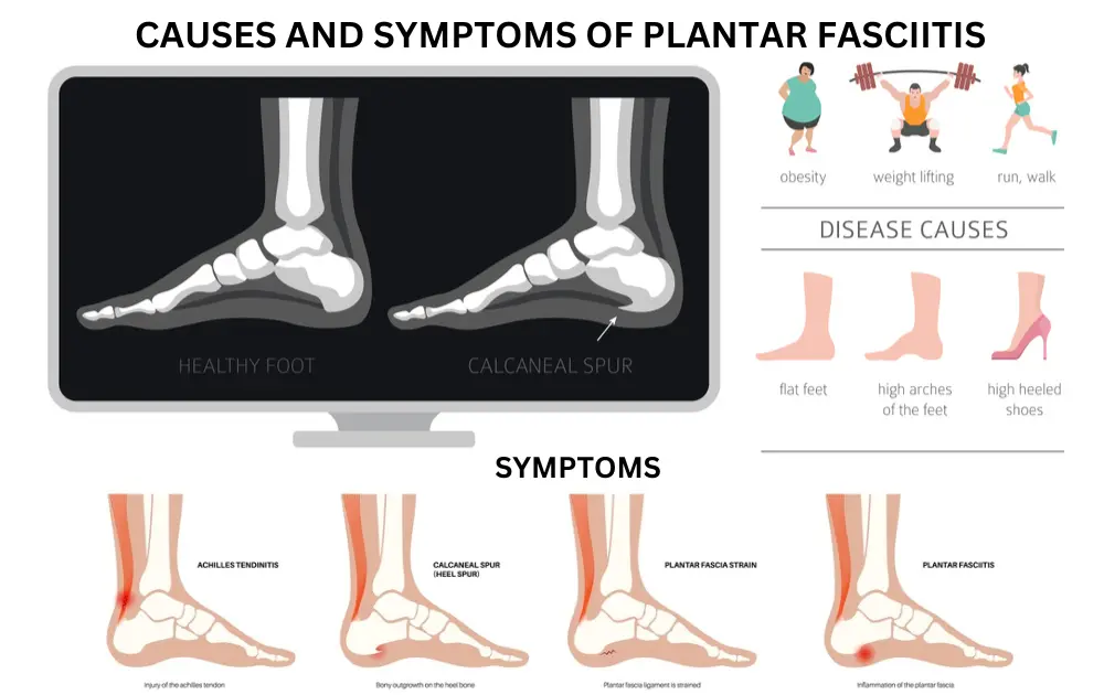 Causes and Symptoms of Plantar Fasciitis