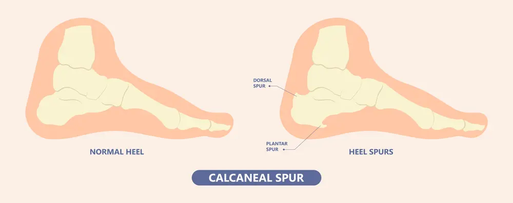 Formation of Heel Spur due to Plantar Fasciitis