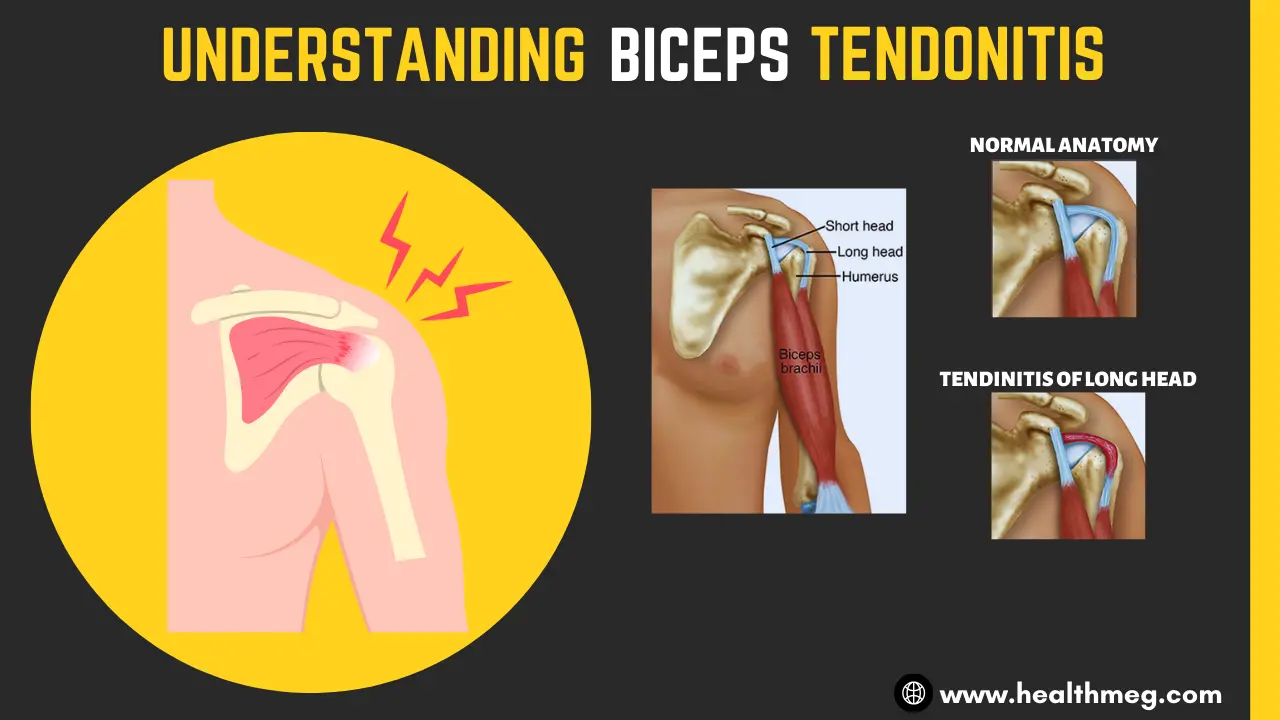 Illustration showing the anatomy of biceps tendonitis in the shoulder.
